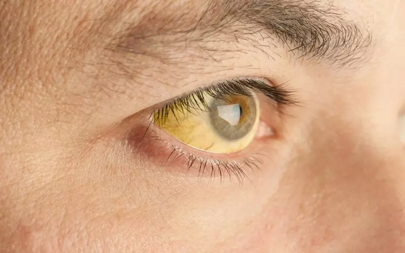 Ung thư gan có thể biểu hiện qua vàng mắt