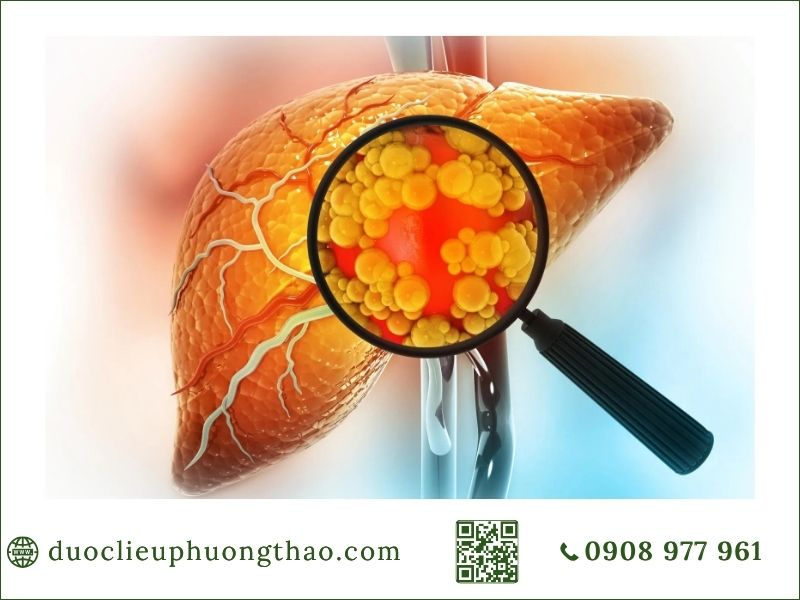 cách điều trị gan nhiễm mỡ