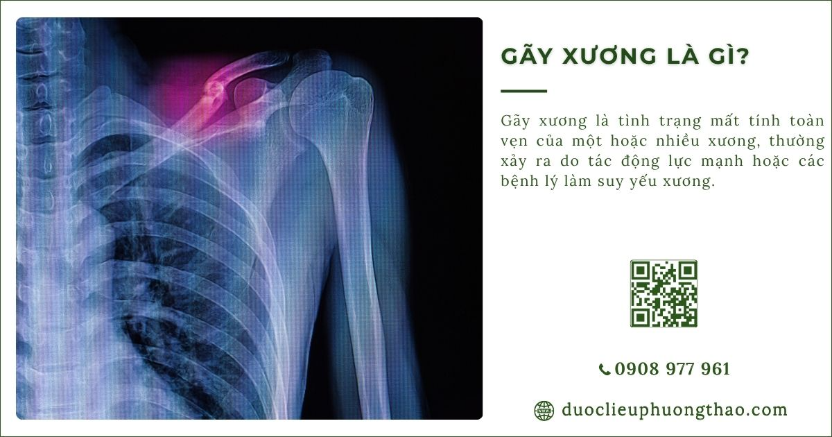 gãy xương là gì