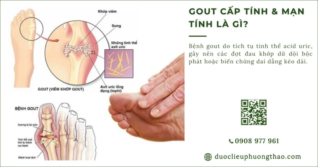 Gout cấp tính và mãn tính là gì? Nguyên nhân, triệu chứng và cách điều trị ở người trung niên