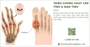 Triệu chứng gout cấp tính, dấu hiệu nhận biết sớm của bệnh gout cấp tính và mạn tính là gì?