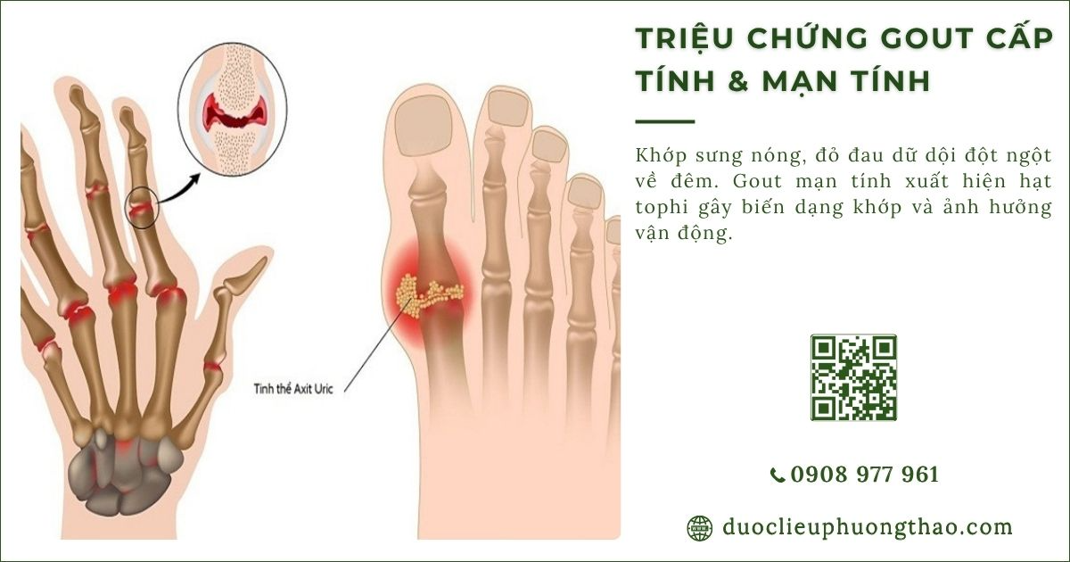 triệu chứng gout cấp tính