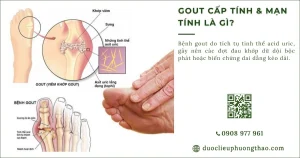 Gout cấp tính và mãn tính là gì? Nguyên nhân, triệu chứng và cách điều trị ở người trung niên