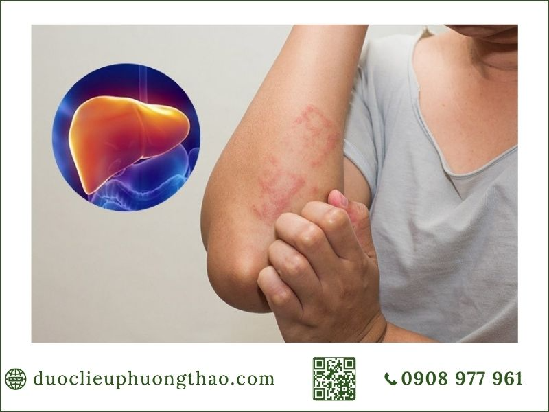 Điều trị nóng gan phụ thuộc vào những yếu tố nào?