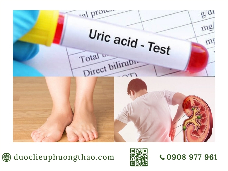 Xét nghiệm axit uric cao và nguy cơ lắng đọng tinh thể urat tại thận, khớp.