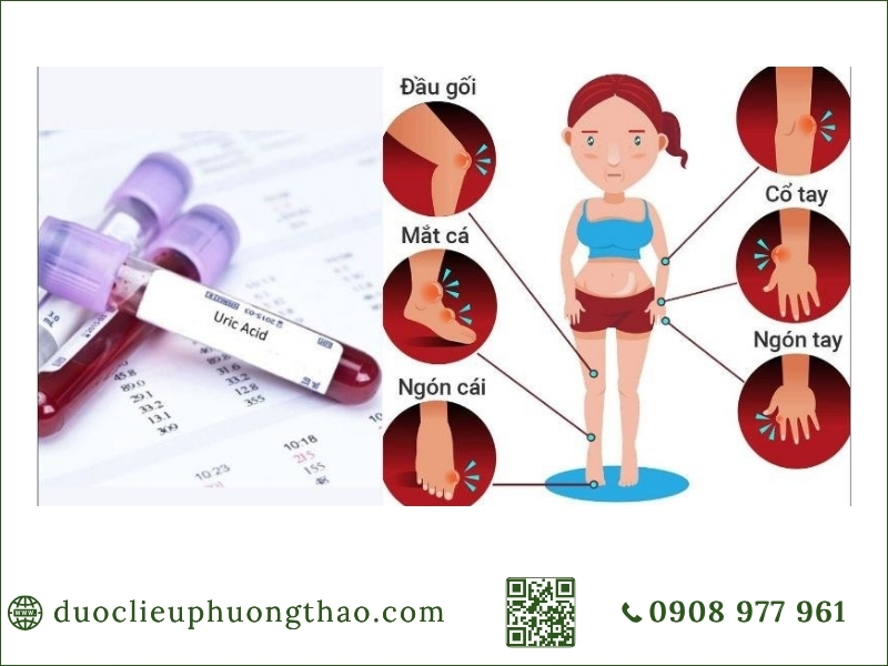 Triệu chứng tăng axit uric máu: Dấu hiệu nào cần lưu ý? Các vị trí khớp thường bị đau sưng và tổn thương khi chỉ số axit uric tăng cao.