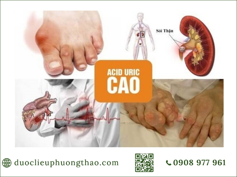 Cách phòng tránh tăng axit uric máu, 6 việc nên làm từ sớm! Acid uric tăng cao kéo dài dễ dẫn đến lắng đọng tinh thể urat tại khớp và thận.