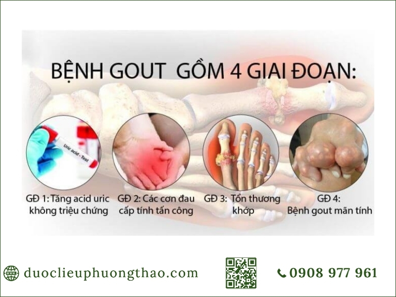 Gout cấp tính và mãn tính là gì? Nguyên nhân, triệu chứng và cách điều trị ở người trung niên nguyên nhân gout cấp tính