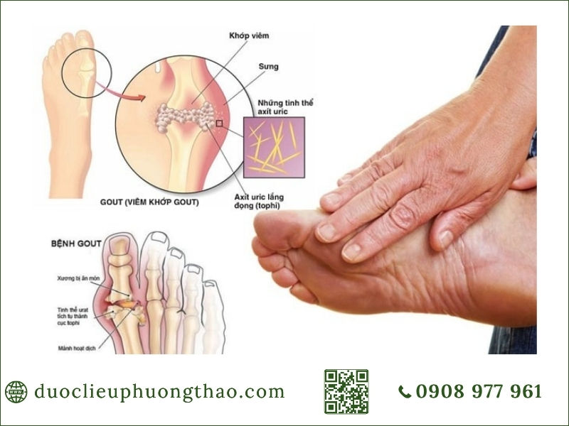 Gout cấp tính và mãn tính là gì? Nguyên nhân, triệu chứng và cách điều trị ở người trung niên gout cấp tính là gì