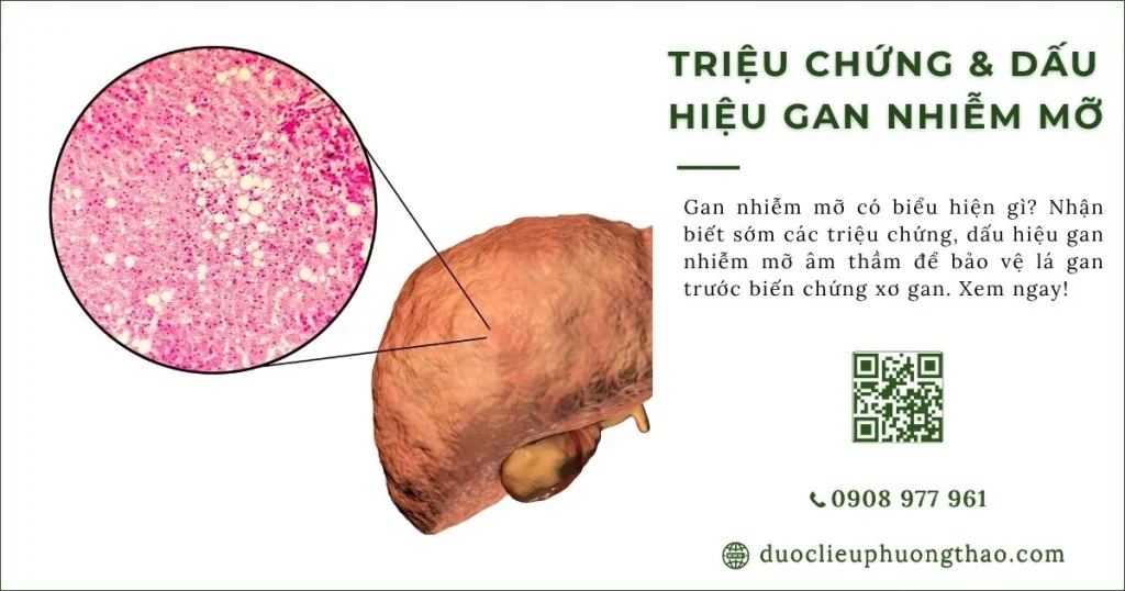 Dấu hiệu và triệu chứng gan nhiễm mỡ có dễ nhận biết không?