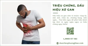 Làm sao nhận biết triệu chứng xơ gan? Các dấu hiệu nhận biết sớm là gì?