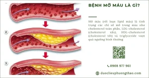 Mỡ máu là gì? Chỉ số, nguyên nhân và cách kiểm soát an toàn tại nhà