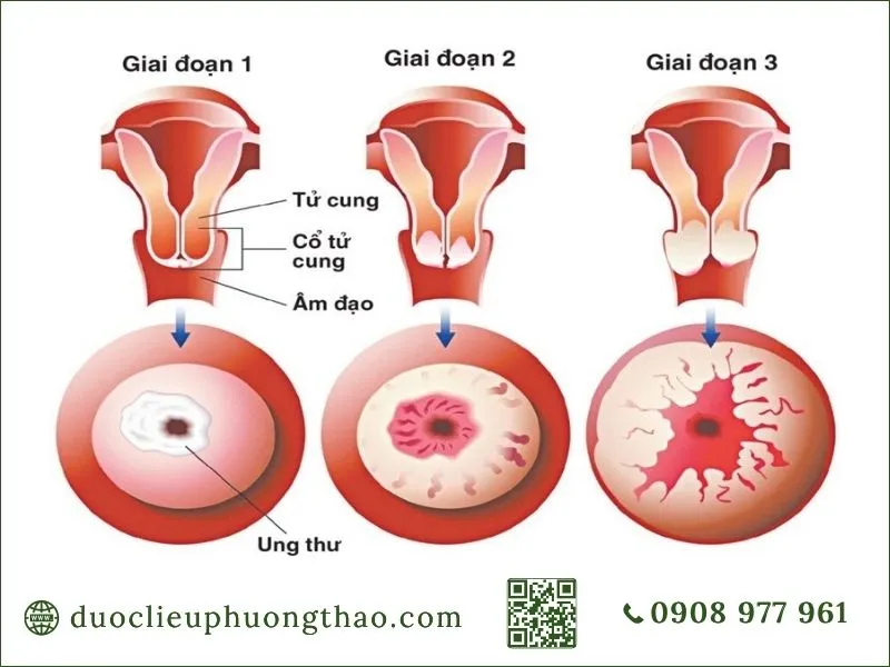U buồng trứng là gì? Dấu hiệu, nguyên nhân và hướng xử trí phù hợp U buồng trứng là gì? Dấu hiệu, nguyên nhân và hướng xử trí phù hợp