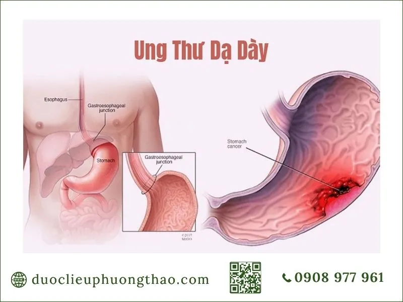 Ung thư dạ dày là gì? Nguyên nhân, dấu hiệu và hướng xử trí phù hợp Vị trí ung thư dạ dày ở niêm mạc và thân dạ dày