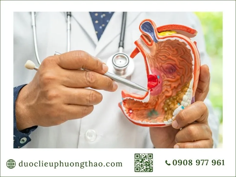 U dạ dày là gì? Nguyên nhân, triệu chứng và cách phòng tránh Mô hình mô phỏng cấu trúc và vị trí u dạ dày khi thăm khám
