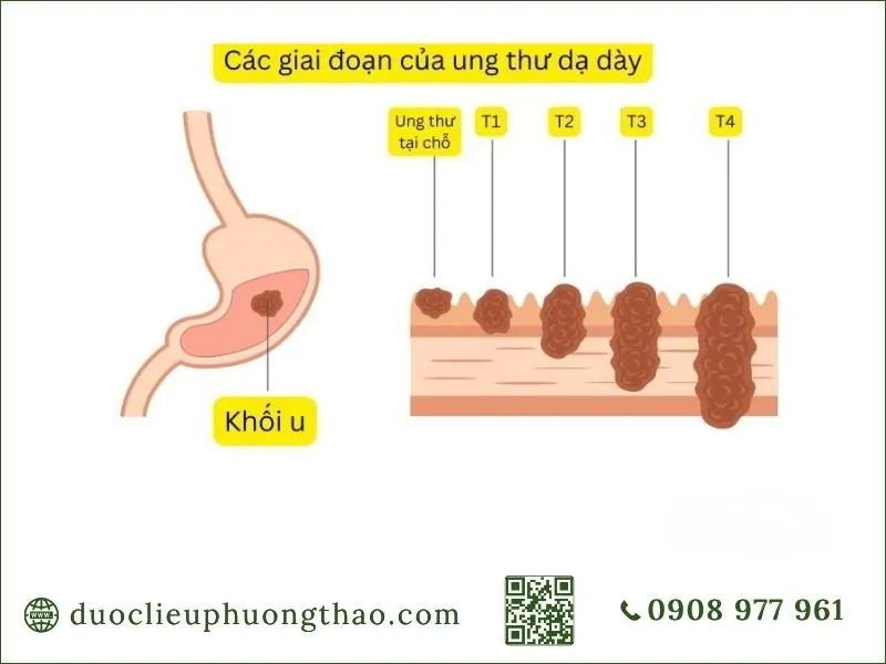 Ung thư dạ dày là gì? Nguyên nhân, dấu hiệu và hướng xử trí phù hợp Các giai đoạn tiến triển của khối ung thư dạ dày từ T1 đến T4