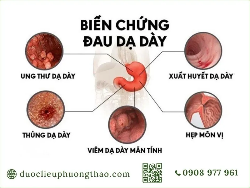 U dạ dày là gì? Nguyên nhân, triệu chứng và cách phòng tránh Các biến chứng u dạ dày gồm ung thư và xuất huyết