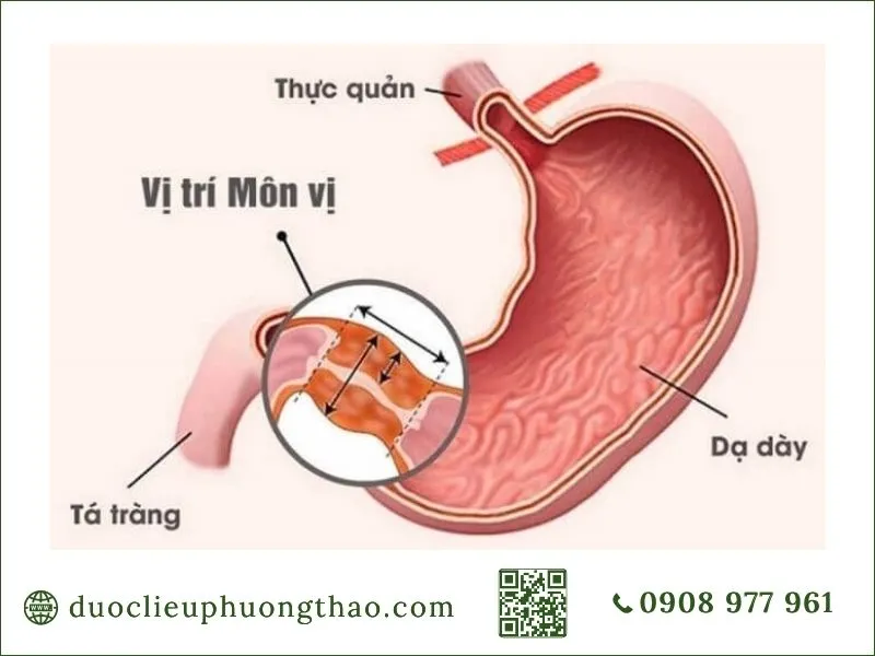U dạ dày là gì? Nguyên nhân, triệu chứng và cách phòng tránh Vị trí môn vị trong cấu trúc dạ dày liên quan u dạ dày