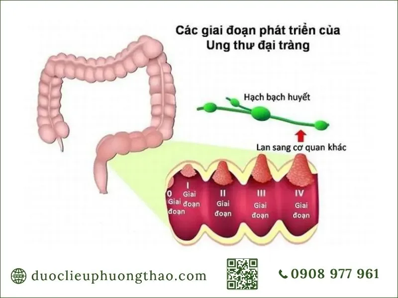 Các giai đoạn phát triển ung thư đại tràng từ giai đoạn 0 đến IV
