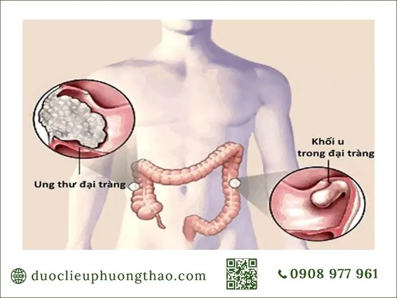 Vị trí khối u đại tràng và ung thư đại tràng