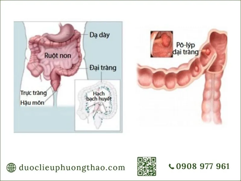 Hình ảnh mô phỏng vị trí polyp và các phần của đại tràng