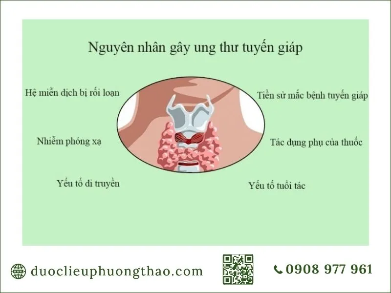 Sơ đồ các nguyên nhân và yếu tố nguy cơ gây ung thư tuyến giáp là gì