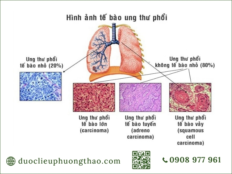 Sơ đồ phân loại các dạng bệnh ung thư phổi là gì, tế bào nhỏ và không tế bào nhỏ