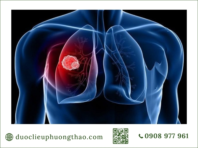 u phổi là gì? Mô phỏng hình ảnh vị trí khối u bất thường xuất hiện ở phổi