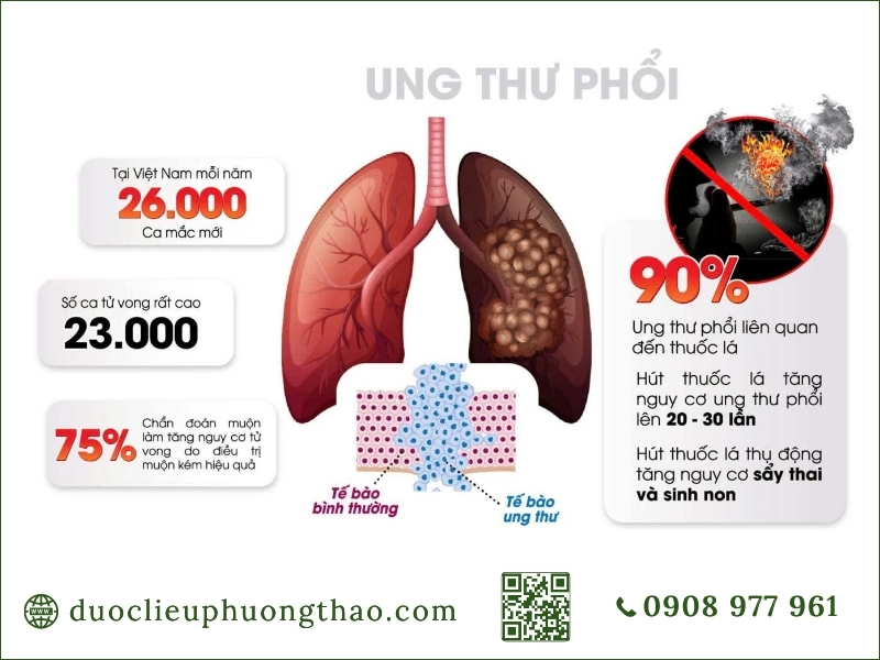 Sơ đồ thống kê tỷ lệ và nguy cơ mắc bệnh ung thư phổi là gì