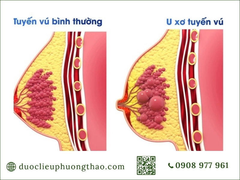 U vú là gì? Nguyên nhân, triệu chứng và cách xử trí an toàn cho chị em phụ nữ so sánh cấu trúc tuyến vú bình thường và u xơ tuyến vú