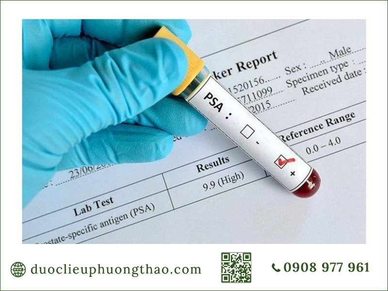 Ung thư tuyết tiền liệt là gì? Nguyên nhân, triệu chứng và cách kiểm soát an toàn cho nam giới Xét nghiệm chỉ số PSA tầm soát ung thư tuyến tiền liệt
