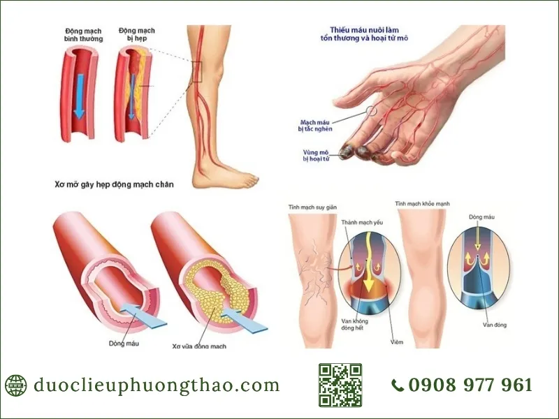 Hình ảnh mô phỏng tình trạng xơ vữa động mạch gây hẹp lòng mạch và biến chứng thiếu máu.