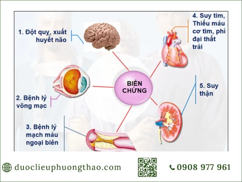 tăng huyết áp là gì