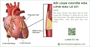 Rối loạn chuyển hóa lipid máu là gì? Nguyên nhân, triệu chứng và cách kiểm soát hiệu quả