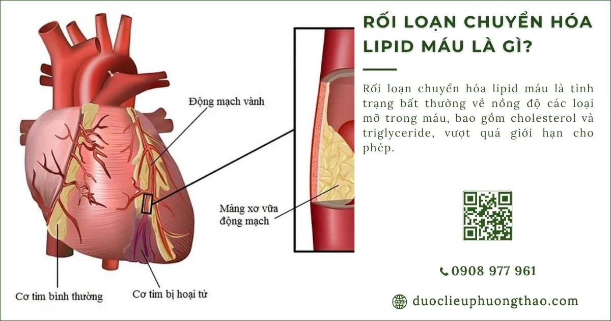 rối loạn chuyển hóa lipid máu là gì