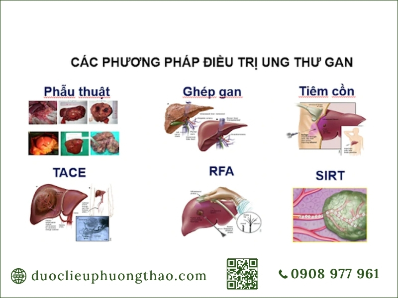 Ung thư gan là gì? Dấu hiệu, nguyên nhân và hướng xử trí Tổng hợp các phương pháp điều trị ung thư gan phổ biến trong y khoa.