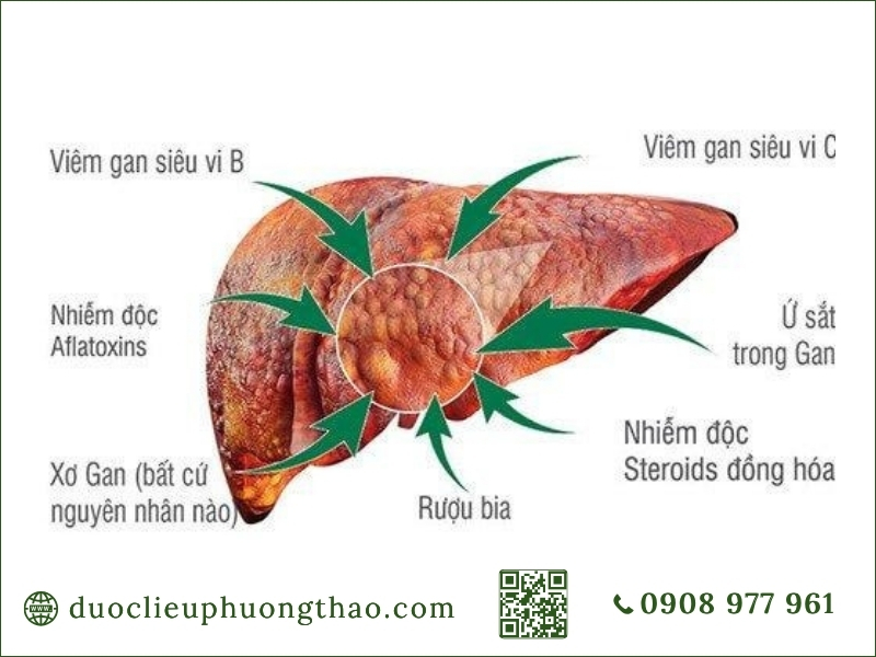 U gan là gì? Phân loại, dấu hiệu, nguyên nhân và cách điều trị Các nguyên nhân hàng đầu làm tăng nguy cơ tổn thương và hình thành u gan là gì