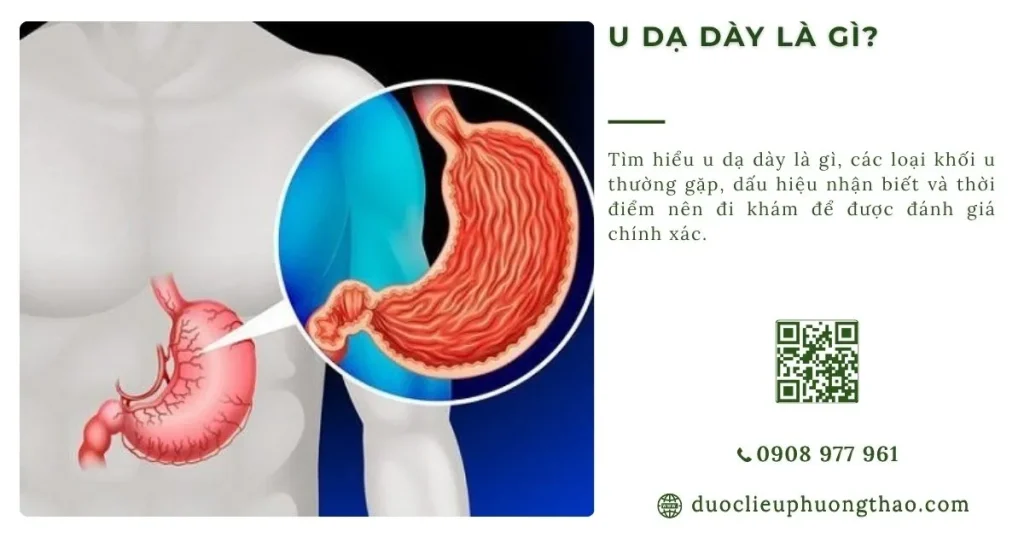 U dạ dày là gì? Nguyên nhân, triệu chứng và cách phòng tránh