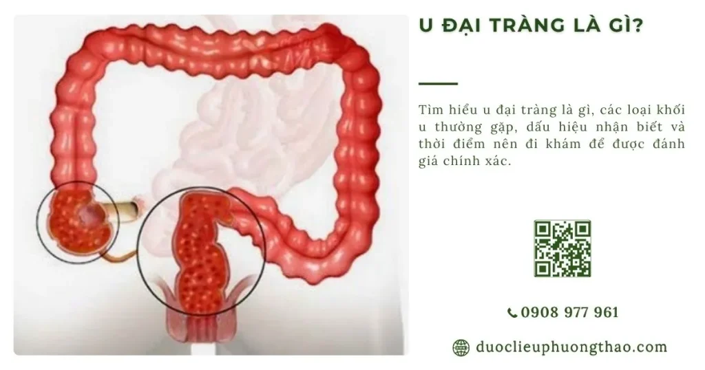 U đại tràng là gì? Nguyên nhân, dấu hiệu, thời điểm nào cần đi khám