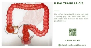 U đại tràng là gì? Nguyên nhân, dấu hiệu, thời điểm nào cần đi khám
