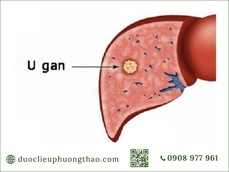 U gan là gì? Phân loại, dấu hiệu, nguyên nhân và cách điều trị u gan là gì