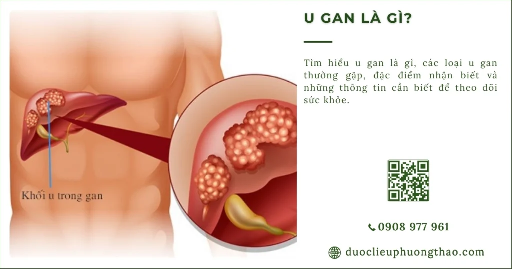 U gan là gì? Phân loại, dấu hiệu, nguyên nhân và cách điều trị