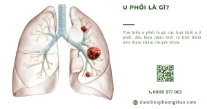 U phổi là gì? Nguyên nhân, triệu chứng và cách xử trí an toàn cho người bệnh