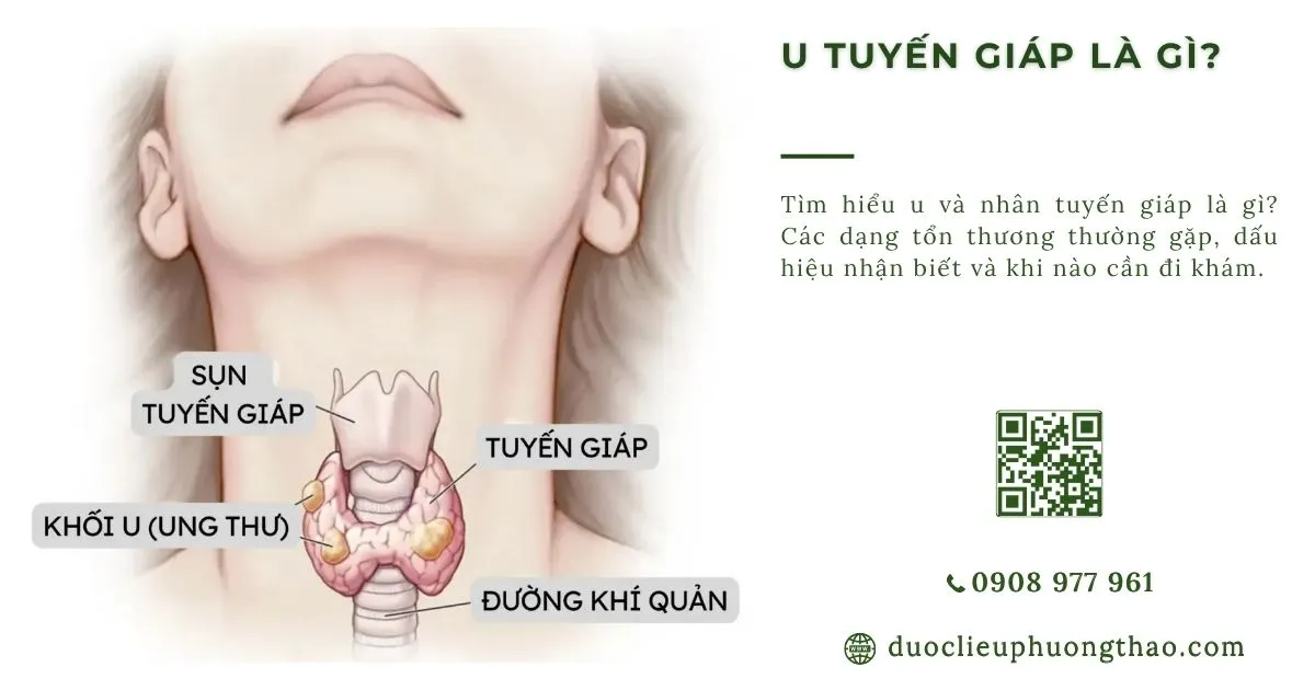 u nhân tuyến giáp là gì