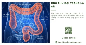 Ung thư đại tràng là gì? Nguyên nhân, triệu chứng và hướng xử lý cho người trung niên