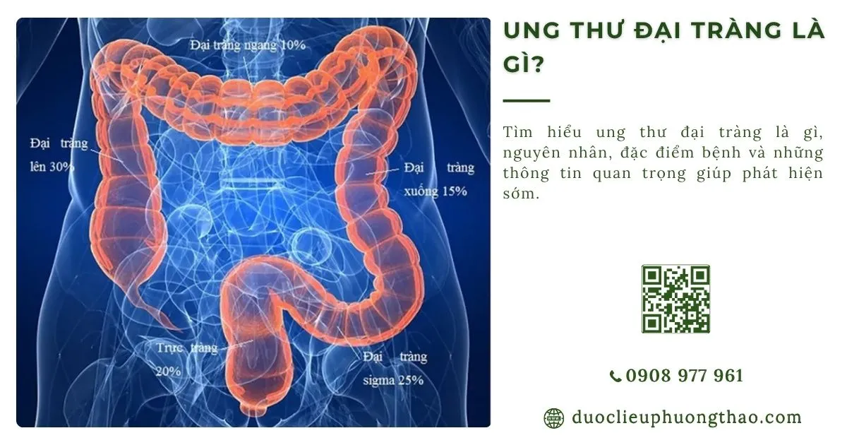 ung thư đại tràng là gì