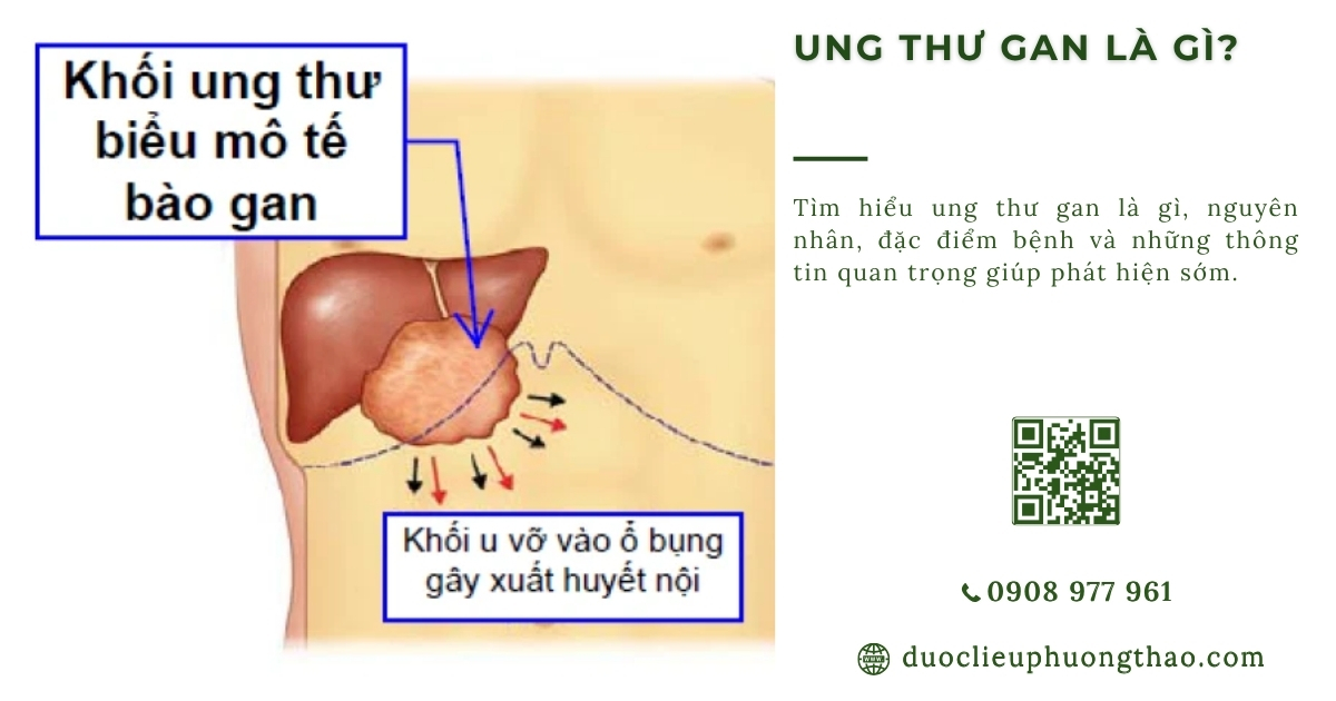 ung thư gan là gì
