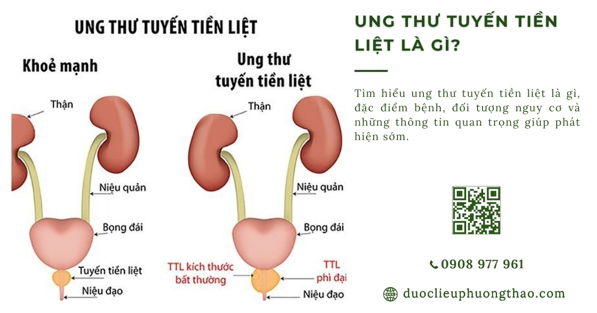 ung thư tuyến tiền liệt là gì
